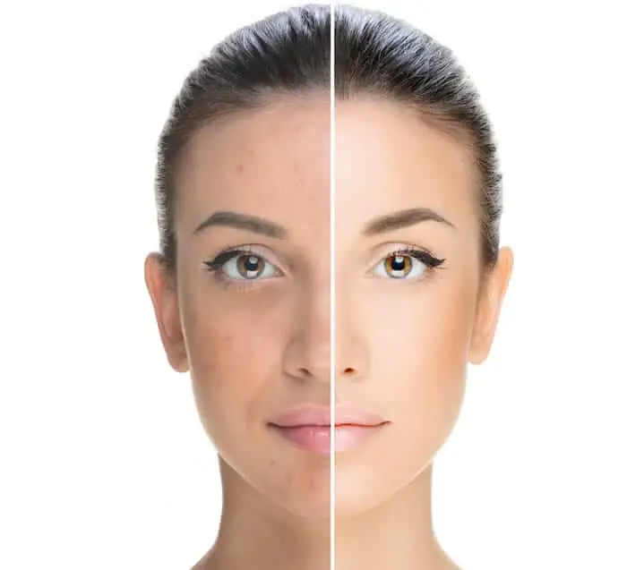 Laser Per Fotoringiovanimento